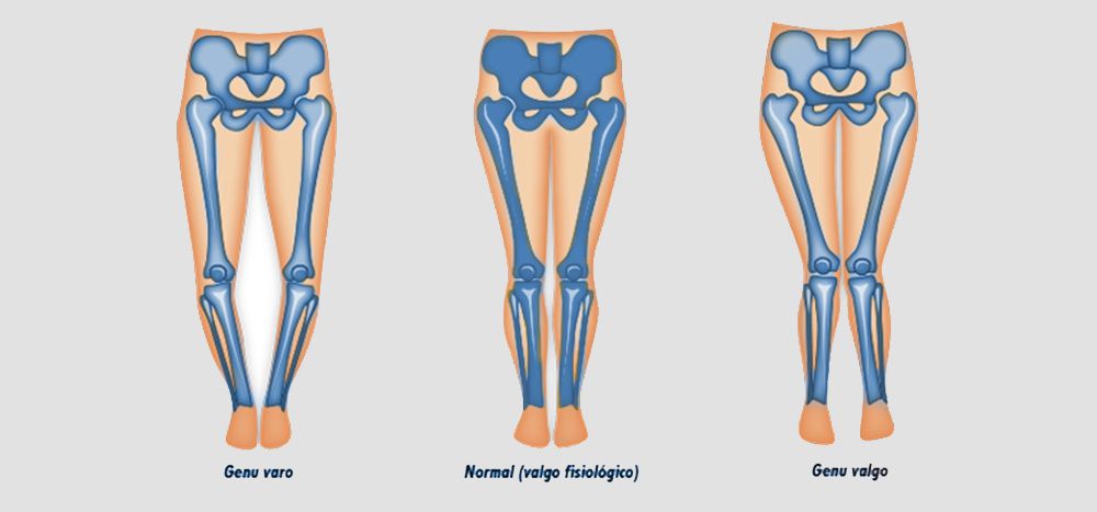 traumatologos-en-monterrey-deformidad-genuvaro-genuvalgo-rodilla-blog-centro-toe.jpg