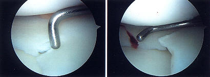 artroscopia rodilla DELGADOTRAUMA fotos