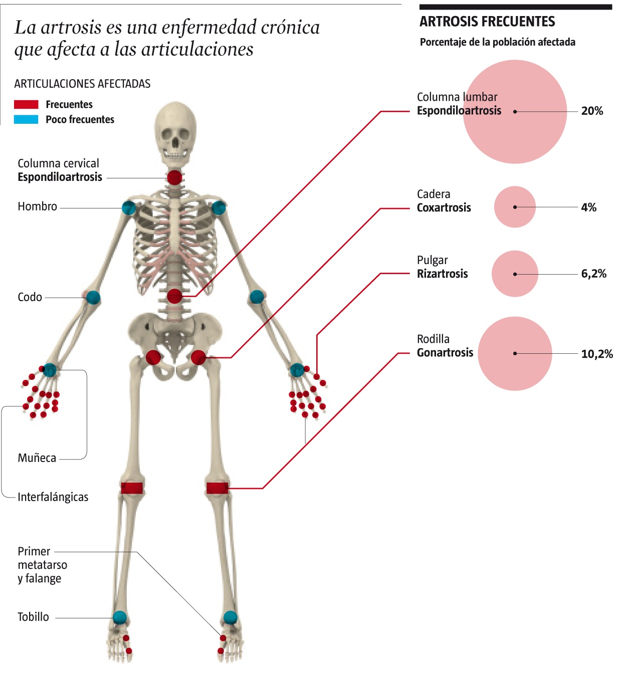 Osteoartroză generalizată primară