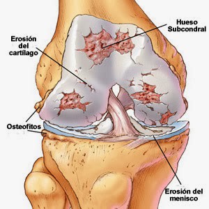 Qué es la Artrosis? -canalSALUD