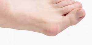 Hallux valgus DELGADOTRAUMA