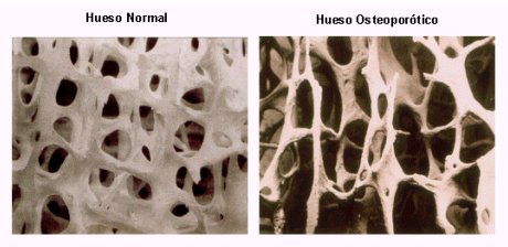Osteoporosis DELGADOTRAUMA