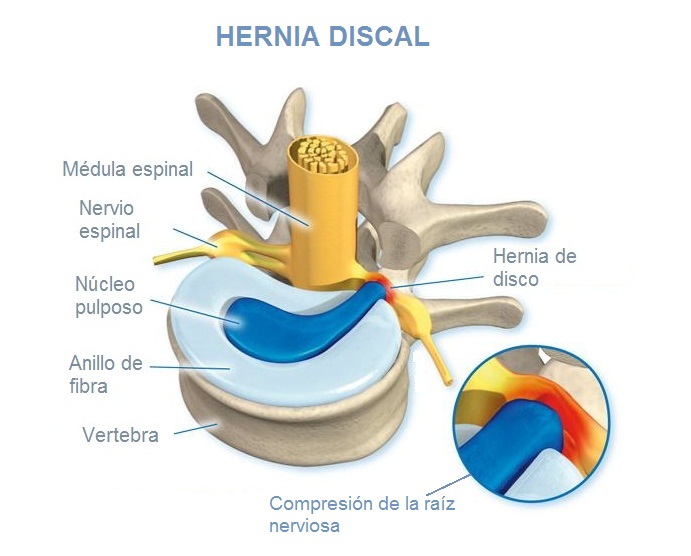 único Humano medios de comunicación Hernia de disco lumbar Dr. Delgado | DELGADOTRAUMA